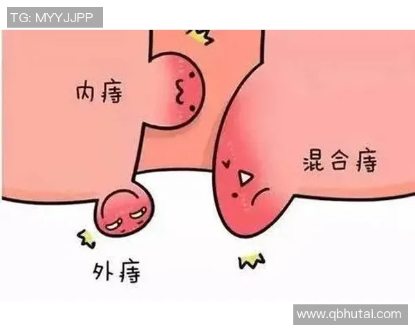 痔疮患者必看的体育锻炼法助你轻松缓解症状与提升生活质量